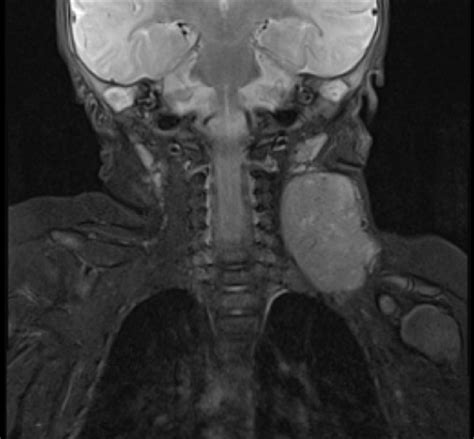 testing soft tissue of the neck|soft tissue neck radiology.